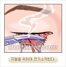 ⁠⁠[두한성형외과 경쟁력 안검성형] - [젊은 눈매를 위한 윗눈꺼풀 지방제거, 눈밑 지방제거] 관련 이미지 17