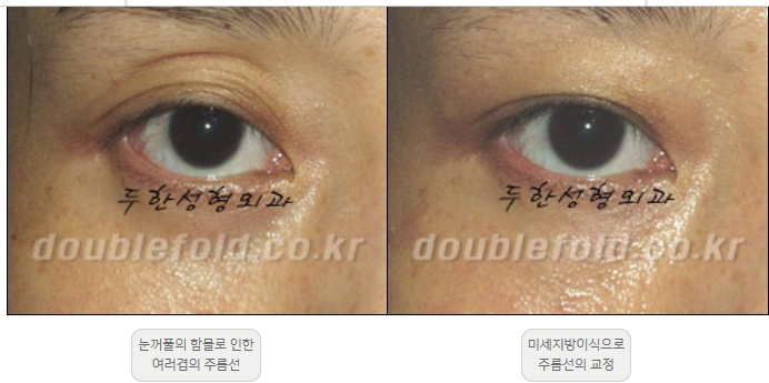 [Double Eyelid Surgery Duhan Plastic Surgery] - [Revision Methods] image 29