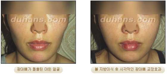 [두한성형외과 얼굴자가지방이식] - [볼살, 이마, 측두부] 관련 이미지 19
