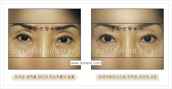 [두한성형외과 경쟁력 눈성형] - [미세지방이식으로 두껍고 어색한 라인 교정 안내 1.] 관련 이미지 7