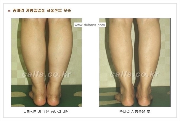 [두한성형외과 경쟁력 멀티종아리성형] - [예쁜 종아리를 만드는 종아리 지방흡입술 안내] 관련 이미지 8