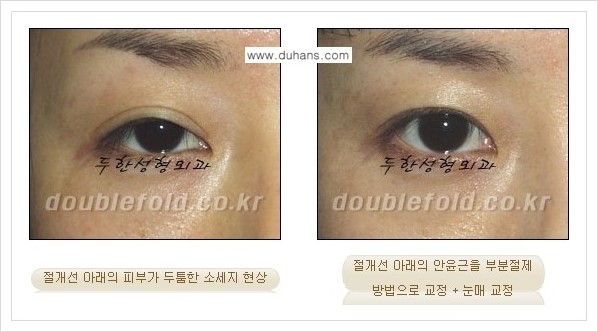 [두한성형외과 경쟁력 쌍꺼풀  재수술, 극한 재수술] - [절개선 아래가 두툼한(소세지 쌍꺼풀) 현상 교정 안내] 관련 이미지 5