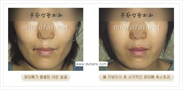 [두한성형외과 경쟁력 안면윤곽 성형] - [광대뼈 돌출, 사각턱, 야윈볼살, 역삼각형의 협소한 얼굴, 측면 볼살의 함몰선, 안면비대칭 미세지방이식] 관련 이미지 7