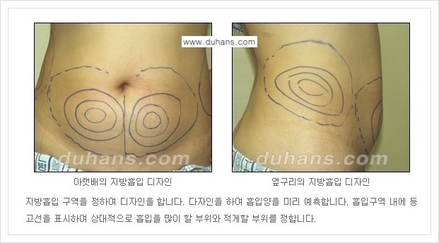 [두한성형외과 경쟁력 지방흡입] - [초음파 간편지방흡입 안내 ②] 관련 이미지 2
