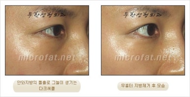 두한성형외과 눈밑수술 - 다크서클 수술 전후 관리 안내 관련 이미지 75