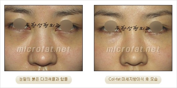 ​[두한성형외과 경쟁력 눈밑성형 리더] - [눈밑 다크써클의 증상, 원인, 종류, 치료방법 안내] 관련 이미지 47