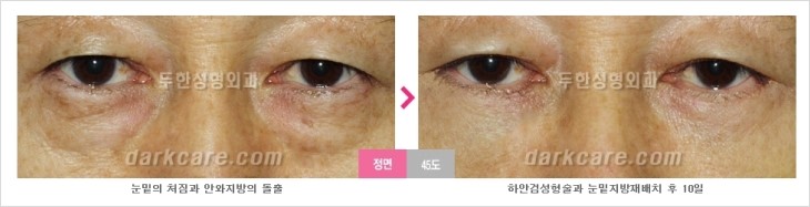 ​[두한성형외과 경쟁력 눈밑성형 리더] - [눈밑 다크써클의 증상, 원인, 종류, 치료방법 안내] 관련 이미지 54