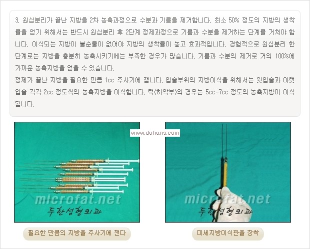 [두한성형외과 경쟁력 미세지방이식] - [입체 미세지방이식으로 주름을 펴면서 볼륨감 있는 입술 만들기] 관련 이미지 4