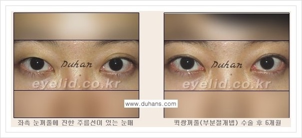 [두한성형외과 경쟁력 쌍꺼풀 재수술, 극한 재수술] - [쌍꺼풀 수술 관련 질문과 답변] 관련 이미지 6
