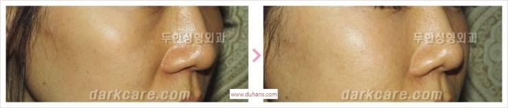 [두한성형외과 경쟁력 멀티성형] - [다크써클 + 인디언밴드 콤비 프로그램 안내] 관련 이미지 11