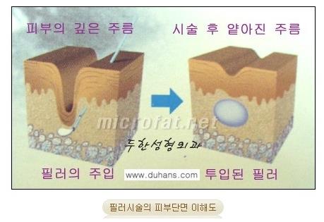 [두한성형외과 경쟁력 퀵성형] - [필러주사(쥬비덤)으로  간단하고 빠르게 주름교정] 관련 이미지 7