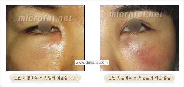 [두한성형외과] - [제대로 된 지방이식으로 부작용에서 탈출하자!] 관련 이미지 2