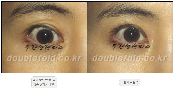 [Duhan Plastic Surgery Double Eyelid Revision] - [Thick Double Eyelid Line] image 46