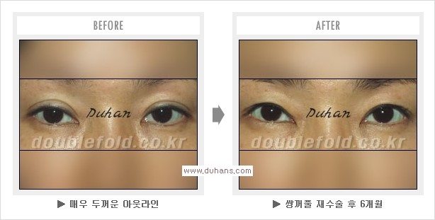[두한성형외과 쌍꺼풀 재수술, 극한 눈재수술] - [재수술에 대한 자주하는 질문과 답변 안내] 관련 이미지 5