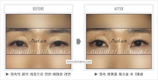 ​[두한성형외과 경쟁력 쌍꺼풀 재수술] - [아름다운 쌍꺼풀 선의 기준과 쌍꺼풀 재수술시 검사와 테스트 안내] 관련 이미지 13