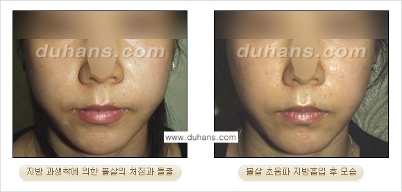 ​​​﻿[두한성형외과 경쟁력 간편지방흡입] - [볼살지방흡입, 턱선지방흡입 안내] 관련 이미지 7