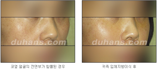 [두한성형외과 얼굴자가지방이식] - [귀족수술 입체 미세지방이식] 관련 이미지 11