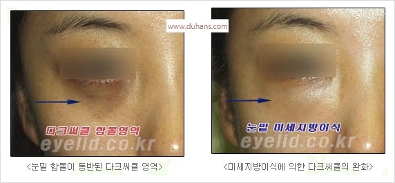 [두한성형외과 경쟁력 눈밑성형] - [눈밑 다크써클 수술 방법] 관련 이미지 11