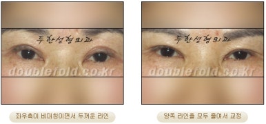 [Duhan Plastic Surgery Eye Surgery] - [Asymmetric Line, Eyelash Eversion, Deep Fixation] image 14