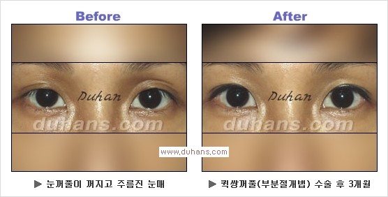 ​[두한성형외과 경쟁력 눈성형] - [자연스러운면서 매력적인 쌍꺼풀 퀵 쌍꺼풀 수술 안내] 관련 이미지 16