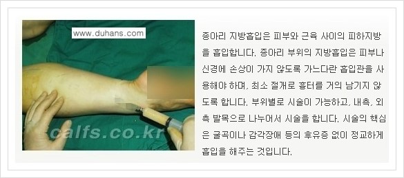 [두한성형외과 종아리 성형] - [매력적인 종아리를 만드는 종아리 지방흡입술 ①] 관련 이미지 6