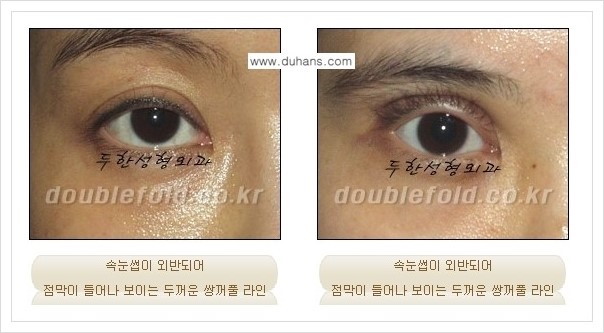 [두한성형외과 경쟁력 쌍꺼풀 재수술, 극한 재수술] - [망가진 눈 복원수술 - 속눈썹 외반 교정 안내] 관련 이미지 1