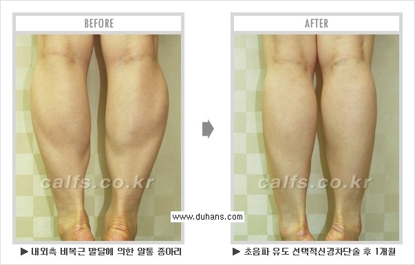 Dr. 컬럼 - 멀티 종아리 성형, 초음파 유도 비절개 선택적 신경차단술 관련 이미지 2
