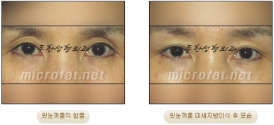 [Doohan Plastic Surgery Autologous Fat Grafting] - [Sunken Eye Fat Grafting] image 11