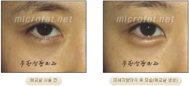 두한성형외과 눈밑성형 - 애교필러 후 눈밑재수술 관련 이미지 53