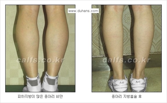 ⁠⁠[두한성형외과 경쟁력 멀티종아리성형] - [지방흡입이 필요한 종아리 비만 안내] 관련 이미지 11