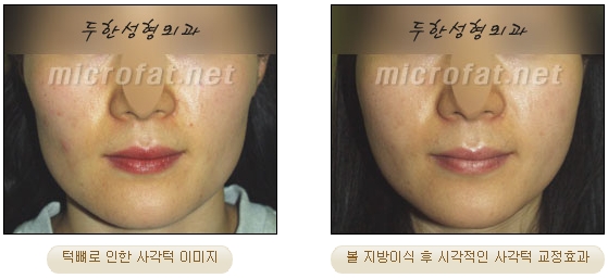 얼굴지방이식 두한성형외과 - 볼지방이식 관련 이미지 20