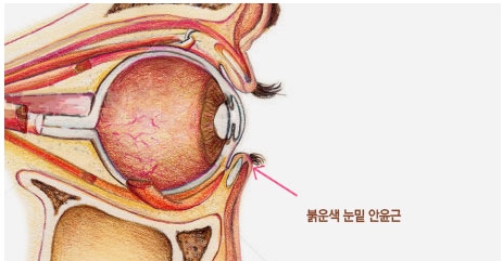 [두한성형외과 눈밑성형] - [다크서클 치료 실패] 관련 이미지 3