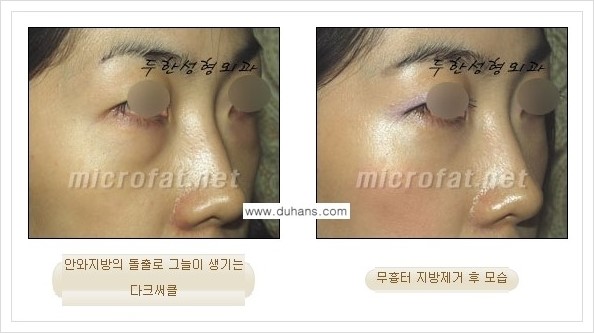 [두한성형외과 경쟁력 눈밑성형] - [눈밑지방제거, 눈위지방제거 안내 1.] 관련 이미지 16