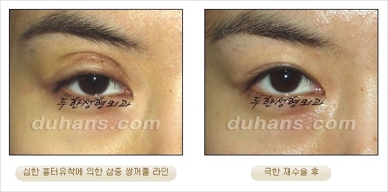 [두한성형외과 경쟁력 쌍꺼풀 재수술 리더 ] - [쌍꺼풀 재수술 과정, 쌍꺼풀 재수술 실패의 원인, 극한 재수술] 관련 이미지 7