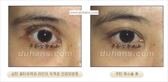 [두한성형외과 경쟁력 눈성형] - [Dr. 컬럼  "어떤 쌍꺼풀이 아름다운 쌍꺼풀인가?!] 관련 이미지 7
