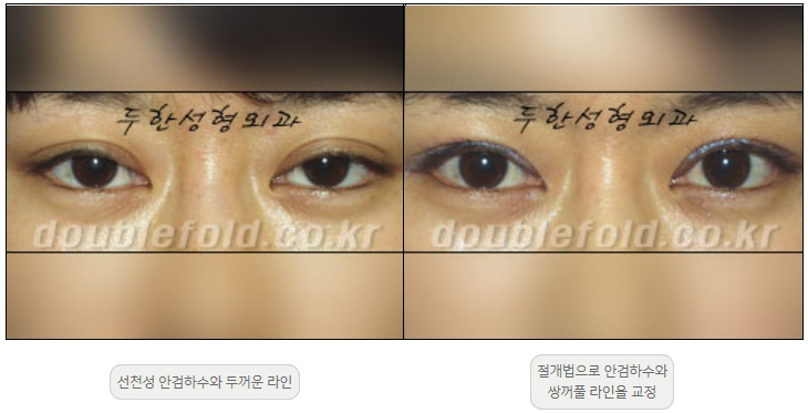 [Ptosis, Duhan Plastic Surgery] - [Sleepy-Looking Eyes, Ptosis Eye Correction] image 12