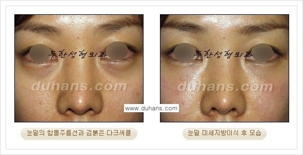[두한성형외과 경쟁력 눈밑성형] - [꺼진 눈밑, 눈밑 함몰 주름선 눈밑 미세지방이식 안내] 관련 이미지 24