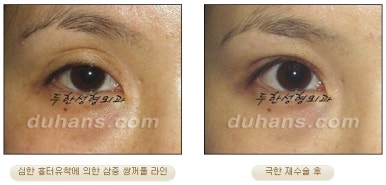 [Special Double Eyelid Revision Surgery at Duhan Plastic Surgery] - [Restorative Surgery for Damaged Double Eyelid Eye Shape] image 6