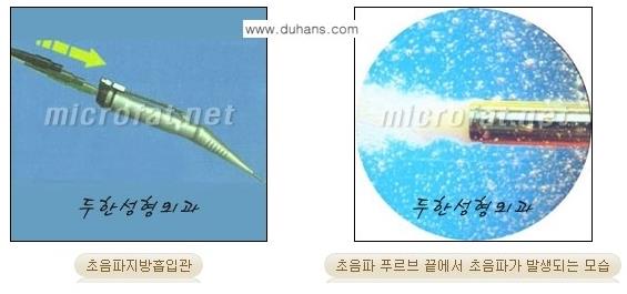 [두한성형외과 경쟁력 바디성형] - [아랫배, 윗배, 옆구리살, 허리살, 팔뚝살 지방흡입] 관련 이미지 3