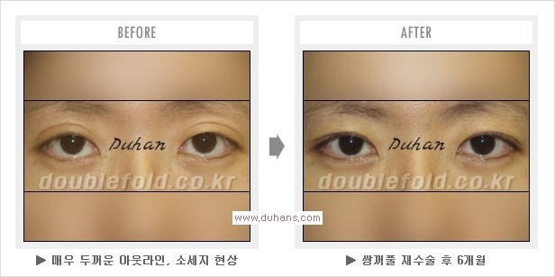 [두한성형외과 경쟁력 눈성형] - [쌍꺼풀 재수술 과정과 쌍꺼풀 재수술 실패의 원인, 쌍꺼풀 재수술의 성공 요건] 관련 이미지 13