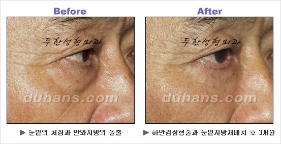 [두한성형외과 경쟁력 동안성형 리더] - ​[미간주름, 이마주름, 안검성형, 이마거상술, 눈썹거상술] 관련 이미지 78