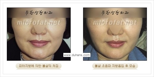 [두한성형외과 겨울엔 지방흡입을] - [볼살, 눈밑, 턱선의 초음파 미세지방흡입 1.] 관련 이미지 12
