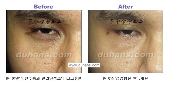 [두한성형외과의 상큼하고 환한 젊은 눈매완성] - [하안검 성형술 ②] 관련 이미지 4