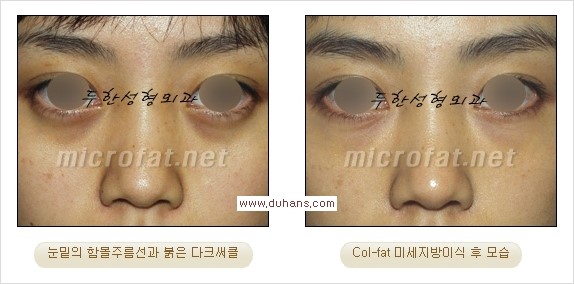 [두한성형외과 경쟁력 눈밑성형] - [Dr. 컬럼 - 눈밑 다크써클의 치료 방법과 치료 효과] 관련 이미지 13