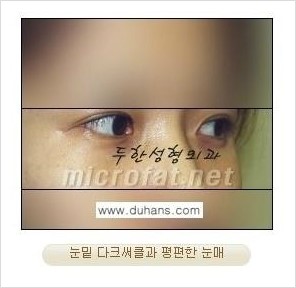 [두한성형외과 경쟁력 눈밑성형] - [눈밑 다크써클과 눈밑 애교살과의 관계] 관련 이미지 2