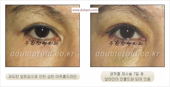 [두한성형외과 경쟁력 눈성형] - [쌍꺼풀 재수술 과정과 쌍꺼풀 재수술 실패의 원인, 쌍꺼풀 재수술의 성공 요건] 관련 이미지 87