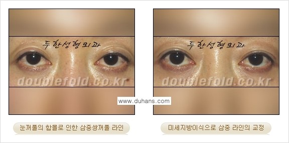 [두한성형외과 경쟁력 눈성형] - [삼중(세겹) 쌍꺼풀 라인의 교정] 관련 이미지 22