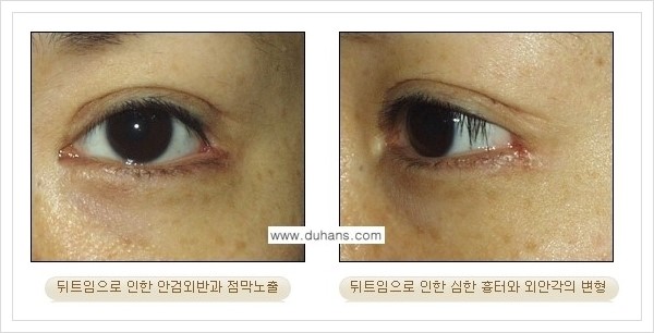 [두한성형외과 경쟁력 눈성형] - [앞트임 복원수술, 뒤트임 수술 안내] 관련 이미지 10