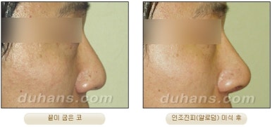 DuHan Plastic Surgery Revision Rhinoplasty - AlloDerm Nose Surgery, SureDerm Nose Surgery image 16