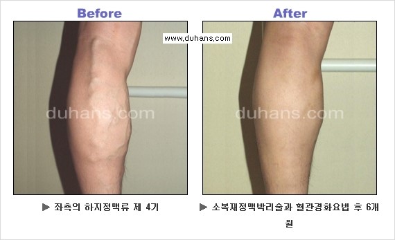 [두한성형외과 경쟁력 정맥류 치료] - [정맥류 치료의 모든 것] 관련 이미지 21